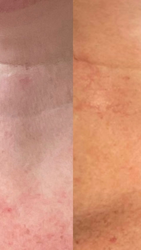 Before and After Profhilo treatment clcose up image